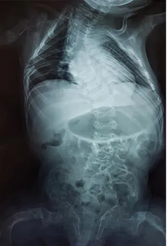 Fig. 3 - Marcada deformidad de la caja torácica y la columna dorso lumbar con escoliosis  