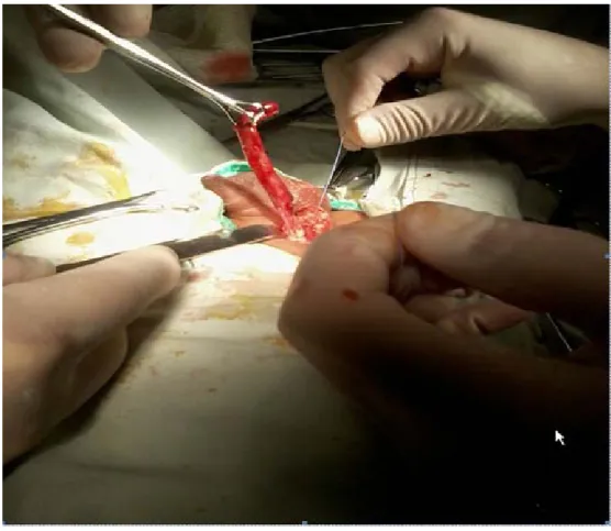 cuadro sea confundido con una hernia complicada en el periodo preoperatorio. 2,15   