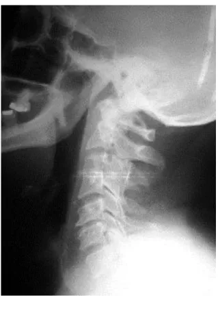 Figura  1.  Rayos  X  de  columna  cervical  lateral.  Rectificación 