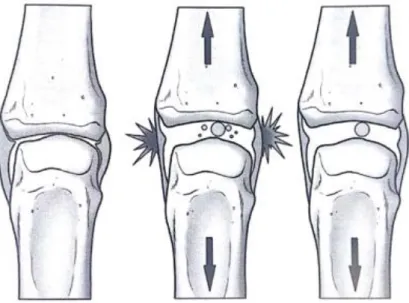 Figura 3. Chasquido articular 4 . 
