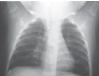 Figura 4. Radiografía de tórax infiltrado intersticial.  Tomado de: Zenteno, D., Girardi, G