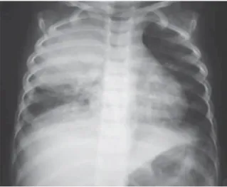 Figura 5. Radiografía de tórax con infiltrado alveolar.  Tomado de: Zenteno, D., Girardi, G