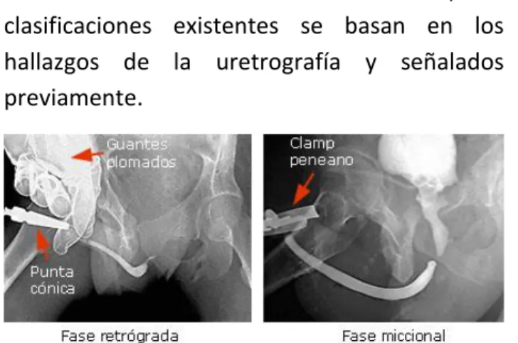 Fig. 5. Uretrocistografía retrógrada y miccional 