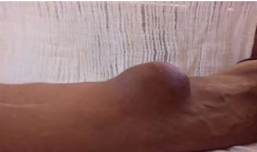 Fig. 1 Gran tumoración pulsátil correspondiente con pseudoaneurisma 