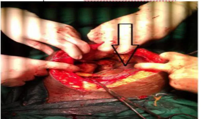 Fig. 1 Visualización de la implantación mesentérica de la placenta y membranas  ovulares adheridas a la pared abdominal posterior a la extracción fetal