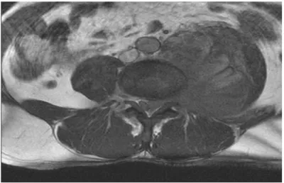 Fig. 1 Imagen de la resonancia magnética nuclear del tumor. 