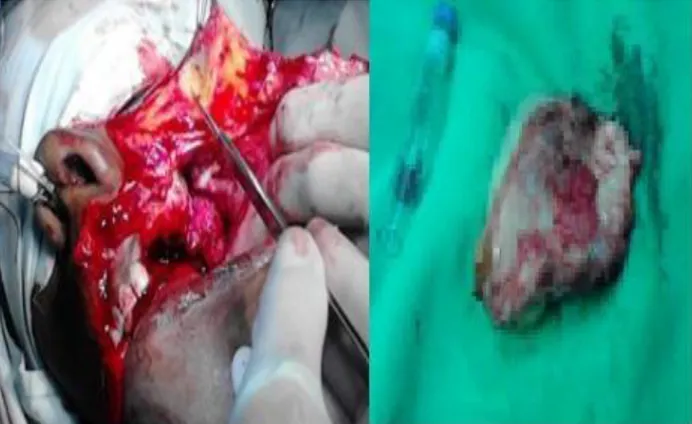 Figura 4. Abordaje quirúrgico y muestra para  biopsia. 