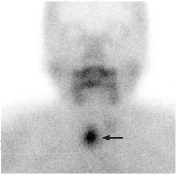 Figura 2. Gammagrafía de paratiroides (imagen planar) realizada 