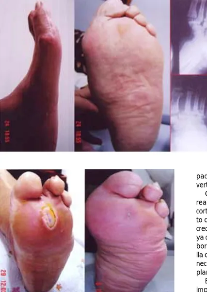 Figura 13. Úlcera neuropática en pie de Charcot.