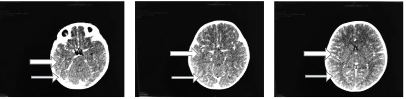 Fig. 1. TAC de cráneo contrastada que evidencía edema cerebral leve generalizado (flecha gruesa) asociado a intenso realce meníngeo (flecha  delgada), apoyando el diagnóstico de meningoencefalitis.