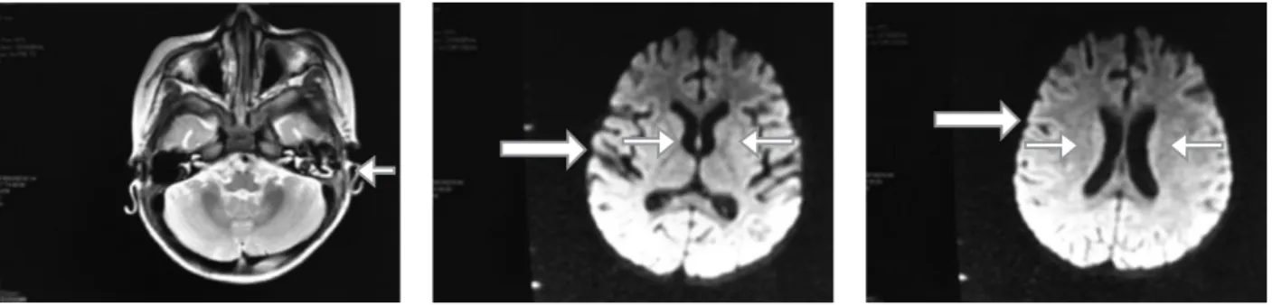 Fig. 2. RMN cerebral que muestra atrofia cortico subcortical (flecha gruesa), probable gliosis periatrial bilateral de tipo inespecífico (flechas delgadas)  y algunas celdillas mastoideas ocupadas por líquido en el lado izquierdo (flecha corta).