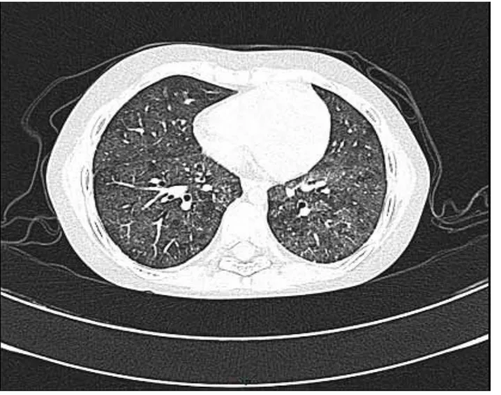 Figura 2. Tomografía de tórax de alta resolución que muestra pulmón con patrón en vidrio despulido en mosaico con zonas de engrosa-