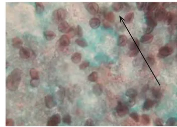 Figura 3. Pneumocystis jirovecii, tinción con metenamina  nitrato de plata. Cortesía: Laboratorio de micología Instituto 