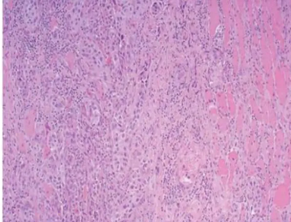 Figura 9. Imagen de carcinoma anaplásico 