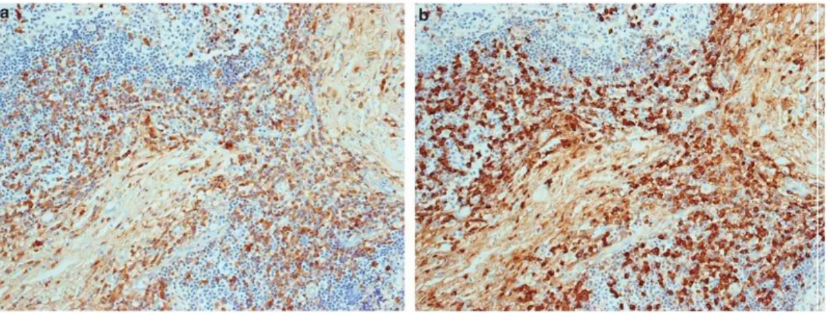 Fig  4.  Inmunotinción  para  IgG  e  IgG4  en  dacrioadenitis  relacionada  con  IgG4
