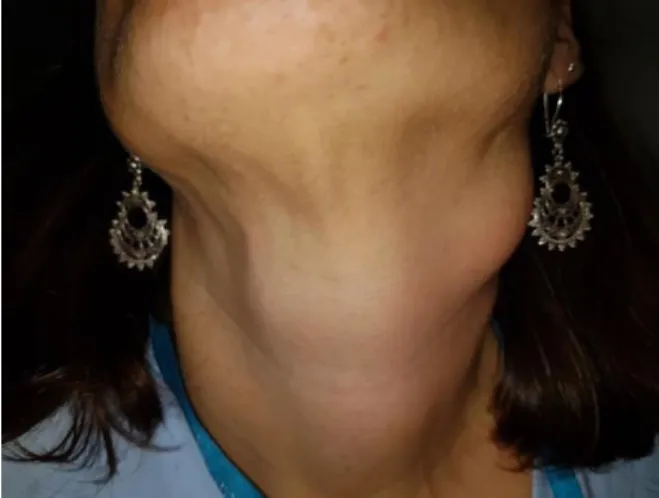 Ilustración 1. Metástasis cervical