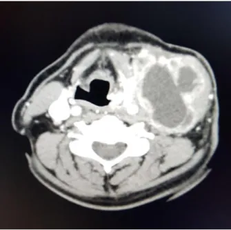 Ilustración 3. Metástasis  cervical  (N3)