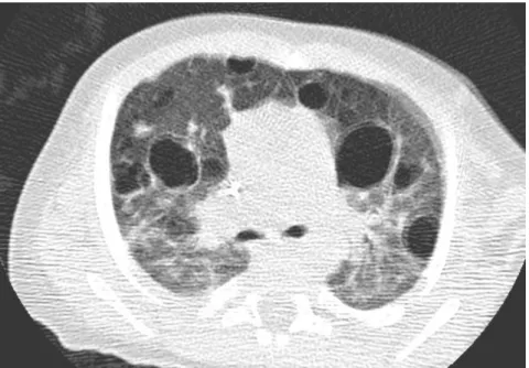Figura 3. Afectación pulmonar en TC. Patrón nodular difuso con múltiples  quistes de diferente tamaño 