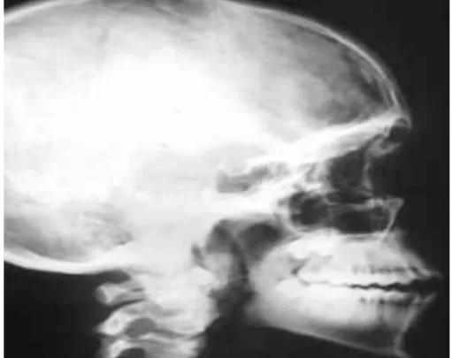 Fig. 1.1 Imagen de rayos gamma 