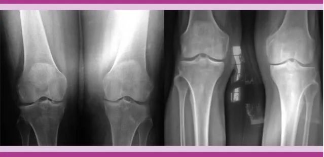 Figura 6. Radiografía anteroposterior de inicio (izquierda) y al año de seguimiento (derecha)