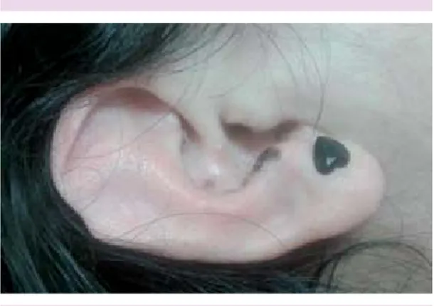 Figura 1.  Eritema y lesiones herpéticas en fase de  costra en oído derecho.