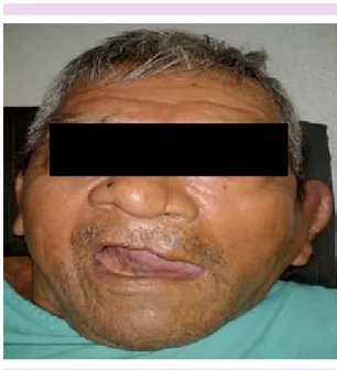 Figura 4.  Parálisis facial periférica izquierda.
