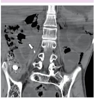 Figura 2.  Tomografía axial computada de abdomen:  cuerpo extraño en retroperitoneo.