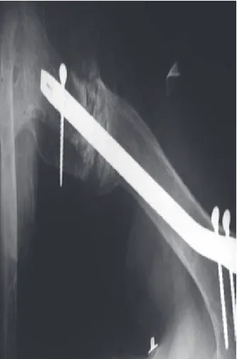 Figura 4. Radiografía anteroposterior de húmero que muestra 