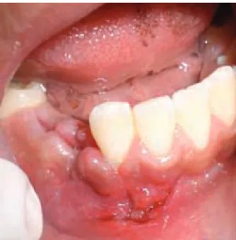 Figura 4. Transoperatorio. Se nota la corona del diente 43 pos-