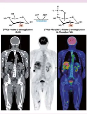 Figura 4.  Análogo de glucosa con un isotopo de flúor  como herramienta diagnóstica de tumores utilizando  tomografía por emisión de positrones.