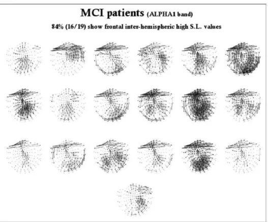 Fig. 3. SL for individual MCI patients (N = 19) in the al band. Black lines indicate electrode pairs with SL two standard deviations above or  below the individual SL average