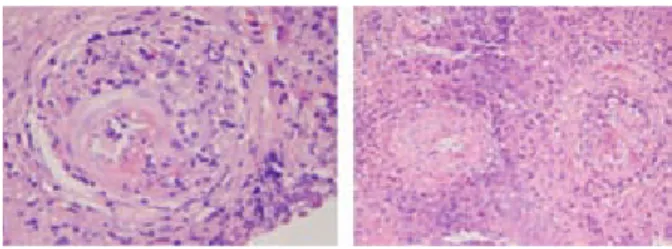 Figura 3 . Biopsia de la nasofaringe que indica proceso granulo-