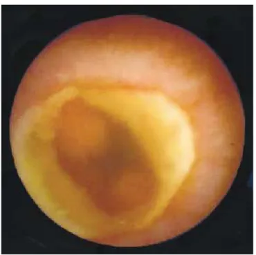Figura 4. Úlceras asociadas a AINEs con sangrado activo y esteno-