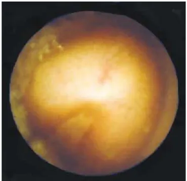 Figura 6. Adenocarcinoma yeyunal ulcerado subobstructivo.Figura 5. Tumor carcinoide ulcerado.