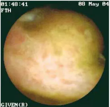 Figura 1. Fotografía de cápsula endoscópica de úlcera en yeyuno