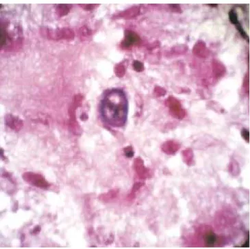 Figura 2. El análisis histopatológico de la biopsia peritoneal mos-