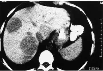 Figura 1. Tomografía computarizada de abdomen donde se mues- mues-tran múltiples lesiones hipodensas en hígado.