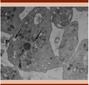Figura 2.  Microscopia electrónica (EM) de las plaque- plaque-tas de la paciente realizado en la Clínica Mayo