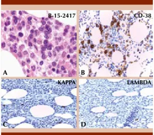Figure 1.  Bone marrow biopsy.  A.  There is interstitial  involvement with myeloma. The neoplastic plasma  cells displayed features from mature to plasmablastic  type (HE