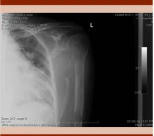 Figure 2.  Osteolytic lesions in left clavicle, rib cage  and humerus.