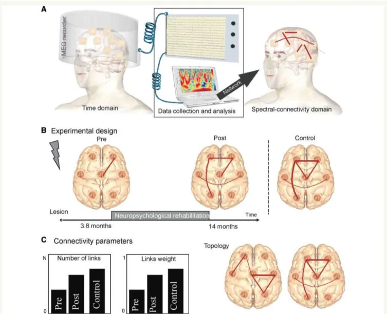 Figure 1  (A) Transformation from time domain (148 MEG time series are recorded) to Connectivity domain (a posterior connectivity  analysis was performed in order to infer the functional connectivity between each pair of signals)