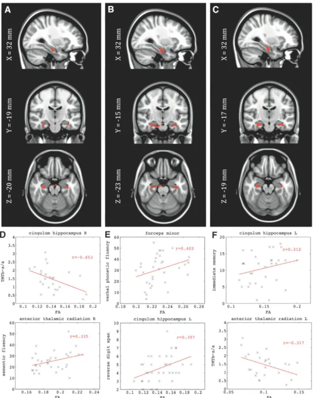FIG. 3. (A-C) Dependency of the FA with the random normalized graph metrics in the aMCI group: (A) Normalized clus- clus-tering in delta band; (B) normalized clusclus-tering in theta band; (C) normalized clusclus-tering in alpha band