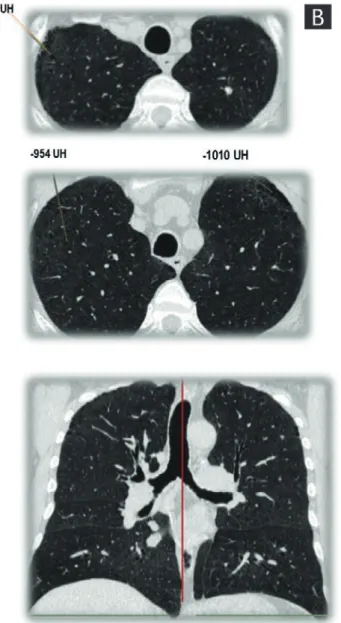Figure 1.  A: 60-year-old male with chronic obstructive pulmonary disease diagnosis. History of smoking for 35 years, 20 ciga- ciga-rettes a day