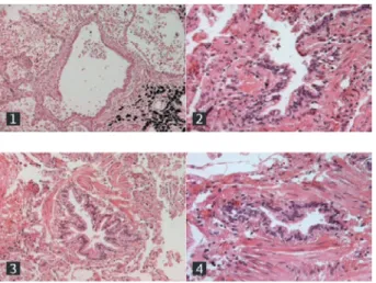 Figure 1. Membranous bronchioles with structural remodel- remodel-ing from mild  (1) to severe (4) in chronic obstructive 