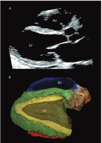Figure 3.  A: a short-axis transthoracic echocardiogram is 
