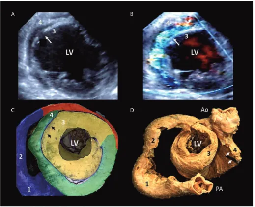 Figure 6.  A: a transgastric echocardiogram shows a post-infarc-