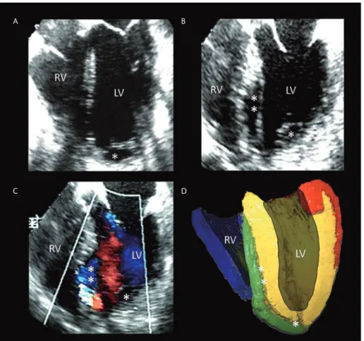 Figure 7. Four chamber transesophageal echocardiograms  (A, B and C) in a patient with myocardial infarction