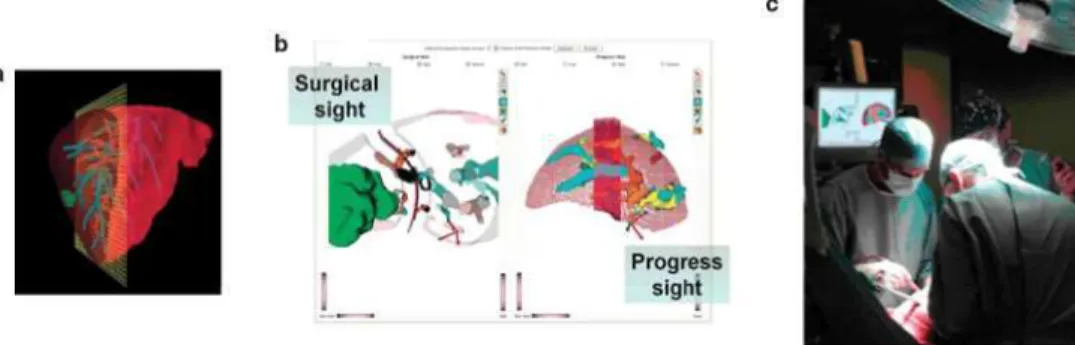 Figure 1. Example of an image-guided surgical system: (a) Liver virtual model; (b) snapshot of the navigation system with the surgical and  progress sight and (c) intra-operative use of the system