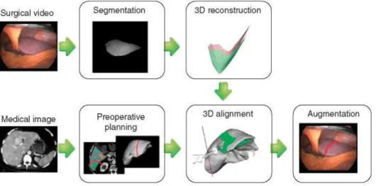 Figure 6. Data pipeline for the augmentation of the surgical view in a liver resection procedure, where the resection line decided in a  preoperative stage is overlaid on the surgical image