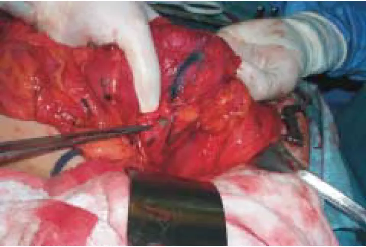 Figure 1. Stained lymph node in the mesentery of the transverse colon.
